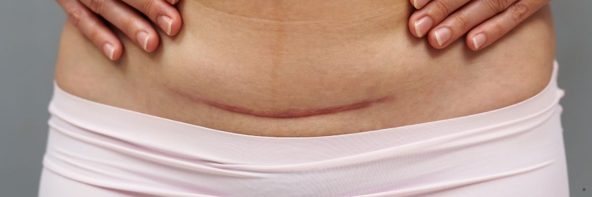 Sezaryen Sonrası Cinsel Sağlık Ne Zaman Normalleşir